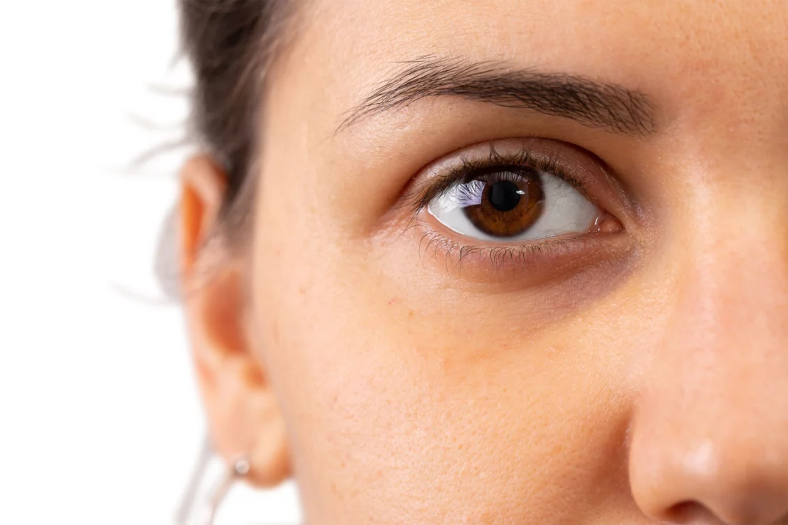 remove dark circles Berlin