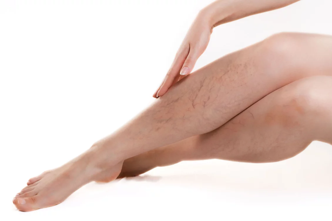 spider veins removal Berlin