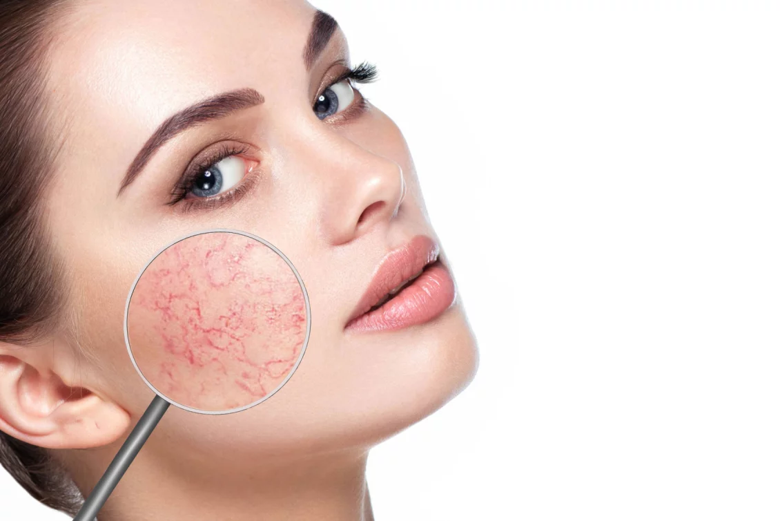Couperose treatment Berlin