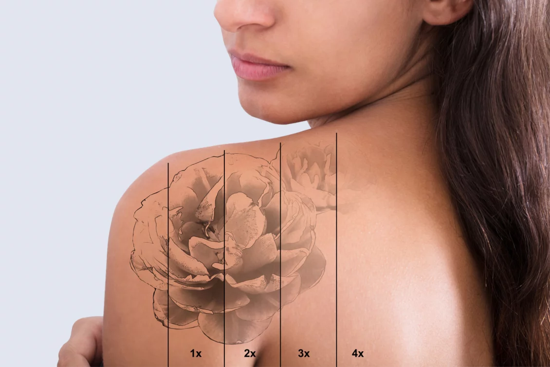 Tattooentfernung in Berlin