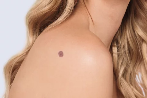 Leberflecken entfernen Berlin