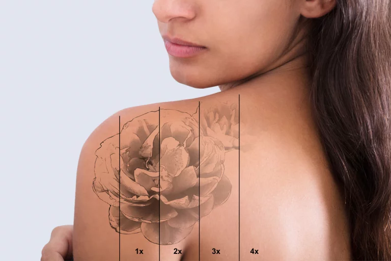 Tattooentfernung in Berlin