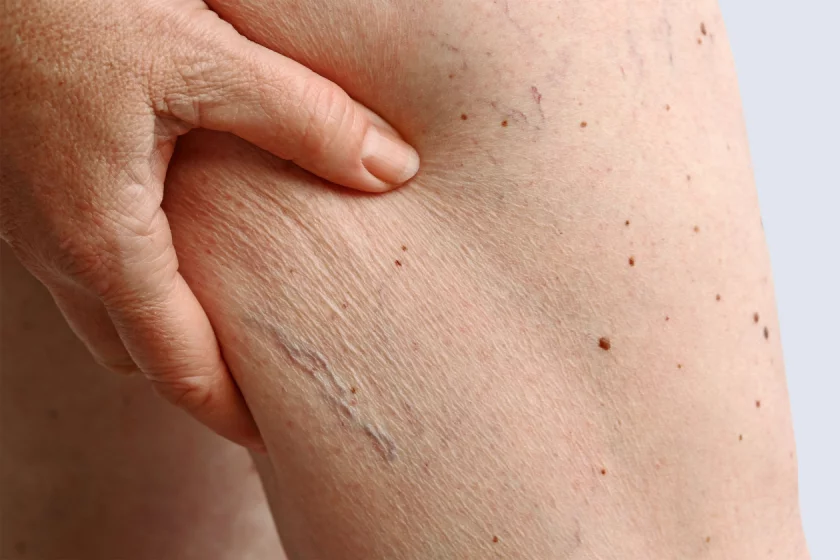 Entfernung von Besenreiser Berlin