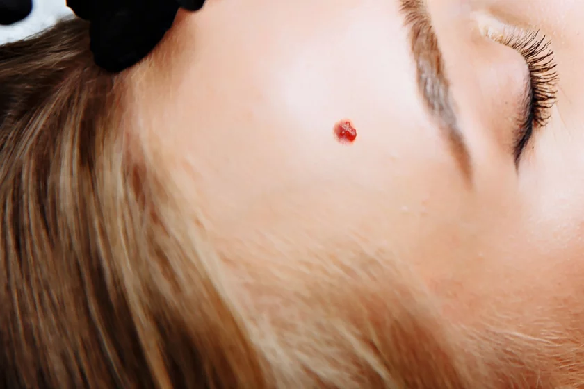 Blutschwämmchen entfernen Berlin