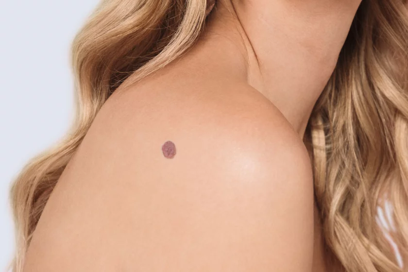 Leberflecken entfernen Berlin